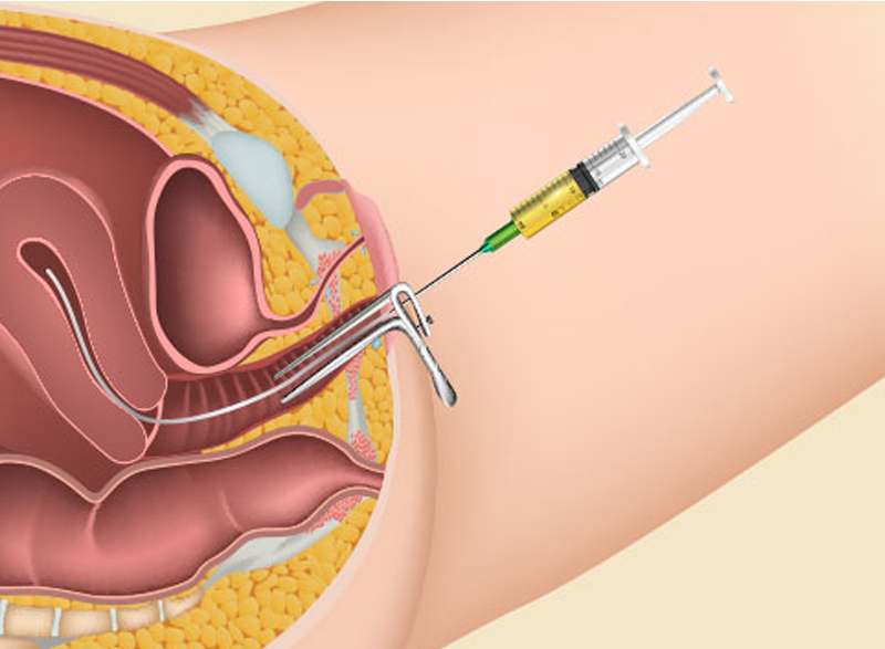 IUI (Intra Uterine Insemination)